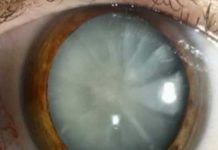 চোখের ছানির প্রতিকার শুধুই অপারেশন