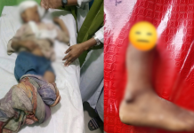 মহেশখালীতে সিএনজি চাপায় পা বিচ্ছিন্ন শিশু আয়েশা আর নেই