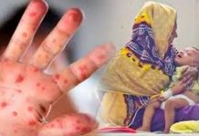 হামের উপসর্গ নিয়ে আরো ১৭ শিশু হাসপাতালে ভর্তি দুইজনের শনাক্ত