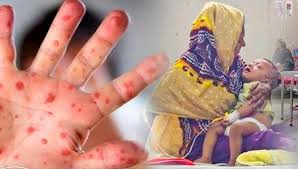 হামের উপসর্গ নিয়ে আরো ১৭ শিশু হাসপাতালে ভর্তি দুইজনের শনাক্ত – দৈনিক আজাদী