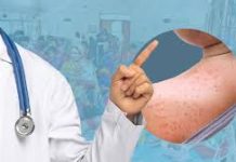 হাম নিয়ে যা জানা জরুরি