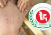 হাম ও উপসর্গ আরো ১৭ শিশুর মৃত্যু
