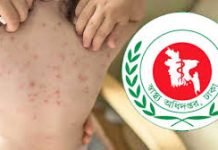 হাম ও উপসর্গ আরো ১৭ শিশুর মৃত্যু