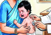 হাম এড়াতে ঈদে শিশুদের নিয়ে সতর্কভাবে চলাচলের পরামর্শ জনস্বাস্থ্য বিশেষজ্ঞদের