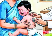 হামের উপসর্গ নিয়ে প্রতিদিন গড়ে ভর্তি হচ্ছে অর্ধশত শিশু