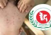 হাম ও উপসর্গ নিয়ে আরও ৪ শিশুর মৃত্যু
