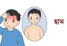 চট্টগ্রামে আরো ২৪ শিশুর হাম শনাক্ত