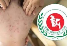 হামের উপসর্গ নিয়ে আরো ৪ মৃত্যু
