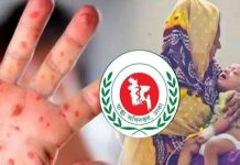 চট্টগ্রামে আরো ১৪ শিশুর হাম শনাক্ত