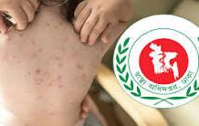 হামের উপসর্গ নিয়ে আরো ৫৯ শিশু হাসপাতালে