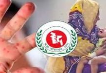 চট্টগ্রামে আরো ১৩ শিশুর হাম শনাক্ত