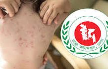 হামের উপসর্গ নিয়ে আরও ৭ জনের মৃত্যু